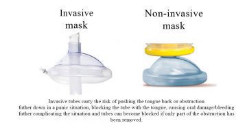 Choking in the news, Dysphagia and invasive suction vs non-invasive suction.
